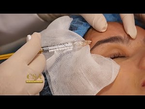 Forehead projection and chin elongation using Korean dermal filler
