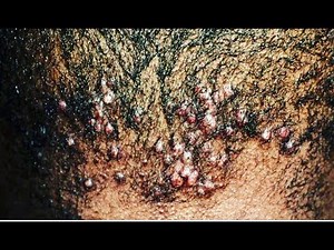 A Closer Look at Folliculitis And How To Treat It...The #Organic Way