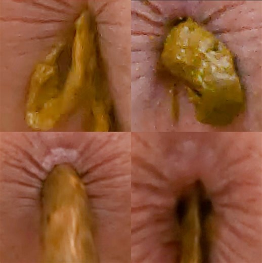 4 Stinky Diarrhea Dumps