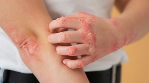 Fungal Infections In Cancer Patients: Doctor Explains Risk Factors And Challenges In Treatment