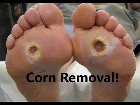 Get Rid of Corns on Your Feet & Toes **2 Minute Fast Cure**