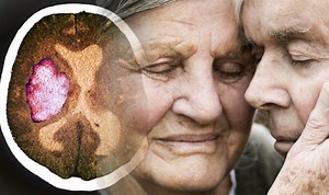 Stroke: Doctor explains the signs and symptoms of a stroke