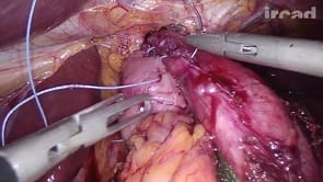 Laparoscopic Heller myotomy with Toupet fundoplication for achalasia | WebSurg, the online university of IRCAD