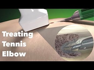 Treating tennis elbow & other tendon issues with TENEX (percutaneous ultrasonic tenotomy)