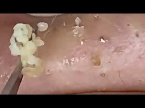 Pimple Popping Videos New • Blackheads On Nose • New Blackhead Popping Videos This Week •