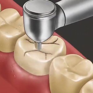 Cartoon video of several treatments: - #Tooth decay removal - #Composite filling - #Inlay - #Teeth whitening The combination of all is questionable, but it gives an idea. #SmileMore #Dentist #dentistryworld #inlay #teeth | Dr Moin Khan