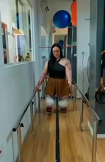 Renata DAK Amputee Lady Walking on Stubbies