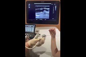 Snapping Extensor Carpi Ulnaris (ECU)