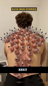 15K views · 29 reactions | Cupping Therapy Explained #highlights #highlightseveryone #trivia #virals #everyone #satisfying #viralpost #fypシ #facts #fypシ゚viral #craft #foryoupageシ #art #megetvfacts #studentlife #student #survival #cuppingtherapy #Cupping | Kuya Mon Stories | Facebook