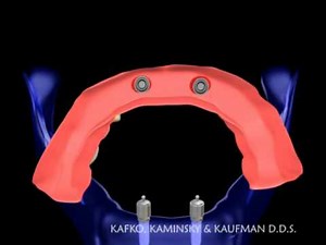 Overdenture with ball attachments