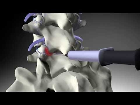 Facet Injection and Medial Branch Nerve Block Patient