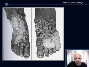 Chromomycosis VIDEO LESSON