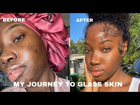 My First Chemical Peel Experience! | Getting Rid of Hyperpigmentation | Lou xoxo