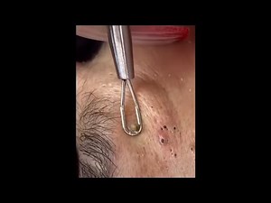 MULTIPLE GIANT Blackhead Removal From EAR (Blackheads Removal Videos 2023) (18.6.23)