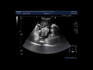 Large Extraperitoneal fluid collection.