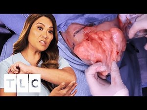 Lip-Oh-Ma-God! The Most Epic Lipoma Removals | Dr. Pimple Popper