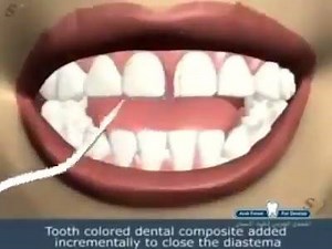 ‪Diastema closure__Dentist | Aesthetic Dentistry | Facebook