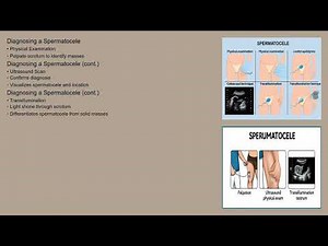 Spermatocele Explained Causes, Symptoms and Treatment, All Insights
