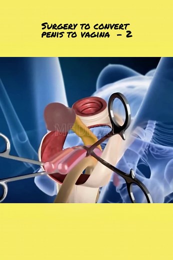 Male Genital Surgery Transformation for Transgender Operations