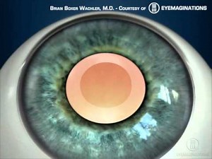 Cataract Surgery Overview