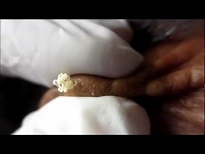 Forehead Sebaceous Cyst