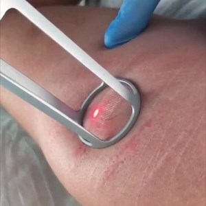 Best Stretch Marks Removal Treatment: Pixel CO2 Laser Skin...
