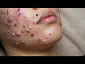 Loan Nguyen Acne Treatment 70ss