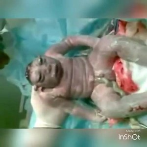 ⚠🔞La anencefalia es una de las anomalías del tubo neural más comunes. Estas anomalías son defectos congénitos que afectan el tejido que crece en el cerebro y la médula espinal. La anencefalia ocurre a comienzos del desarrollo de un feto y se presenta cuando la porción superior del tubo neural no logra cerrarse. El porqué sucede esto no se sabe. Las posibles causas incluyen Baja de ácido fólico ambientales y baja ingesta de por parte de la madre durante el embarazo. La anencefalia se presenta en