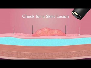 Colonoscopy: Endoscopic mucosal resection of 20 mm colon polyps • Video • MEDtube.net