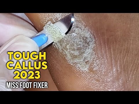 LARGE CALLOUS SHAVING 2023 | CALLUS SHAVING FROM SIDE OF THE FEET ( SATISFYING) BY MISS FOOT FIXER