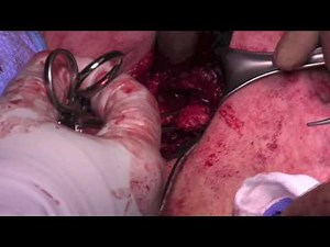 Proximal Hamstring Rupture Primary Repair Using Transverse Incision
