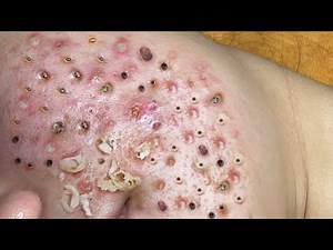 Loan Nguyen Acne Treatment 1046