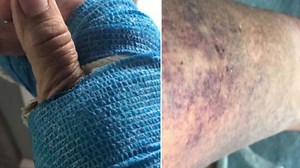 Bay Area woman considers taking legal action against Lime after nasty scooter accident