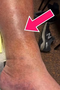 3.2K views | What causes the brown discoloration of the skin in...