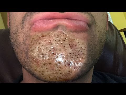WARNING: Blackheads & Dilated Pores of Winer - Bubu Plus Documentary