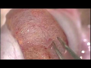 Micro TESE/ Microdissection Testicular Sperm Extraction : A/Prof DG Lusaya, MD, FPUA, FPCS