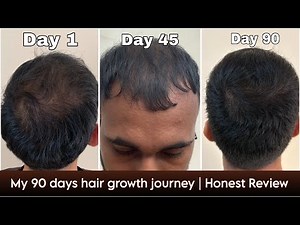 Adon Hair Care Kit 90 Days Honest Review 😳 | Real Hair Regrowth Results (Before & After)