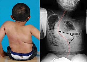 Osteogenesis imperfecta causes, symptoms, types, prognosis & treatment