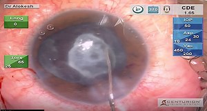 Silicone Oil With Plaque - Eyetube