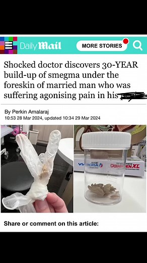 Shocking Discovery: 30 Year Old Smegma Buildup Revealed