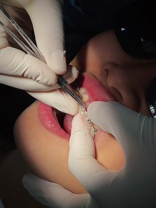 Love ❤️‍🔥#shiningsmiledentalclinic #braces