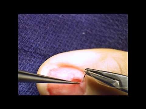 Glomus Tumor Removal