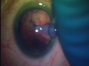 Transpupillary, Trans Posterior Capsulotomy Vitrectomy  - Eyetube