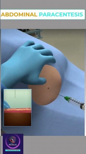 Abdominal Paracentesis Procedure #shorts