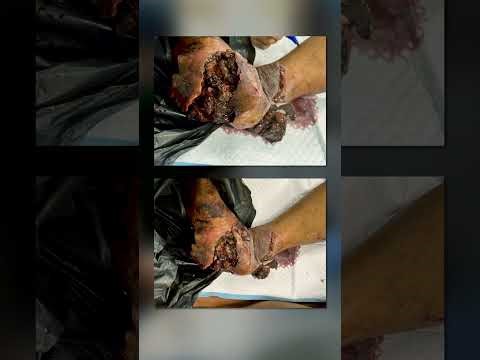 Amputations among civilian men, women, and children are common here