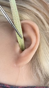 106K views · 149 reactions | Strange material removed from ear. A patient had a strange piece of material removed from their ear. This original video was produced by Rick Lax and Alex Z | Possibly Genius | Facebook