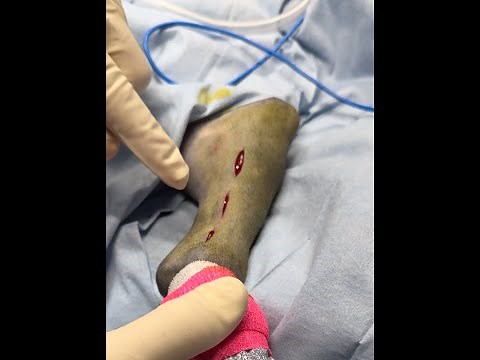 Paws and Procedures 15 Minimally Invasive Tibia Fracture Repair