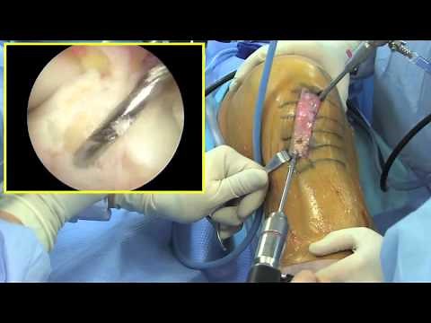 ACL Reconstruction using patellar tendon