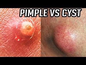 Are Cysts Just Large Pimples? Find Out!