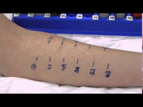 Skin Prick Test At Westside Allergy Specialist Clinic